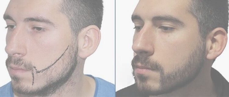 Moustache Hair Transplant
