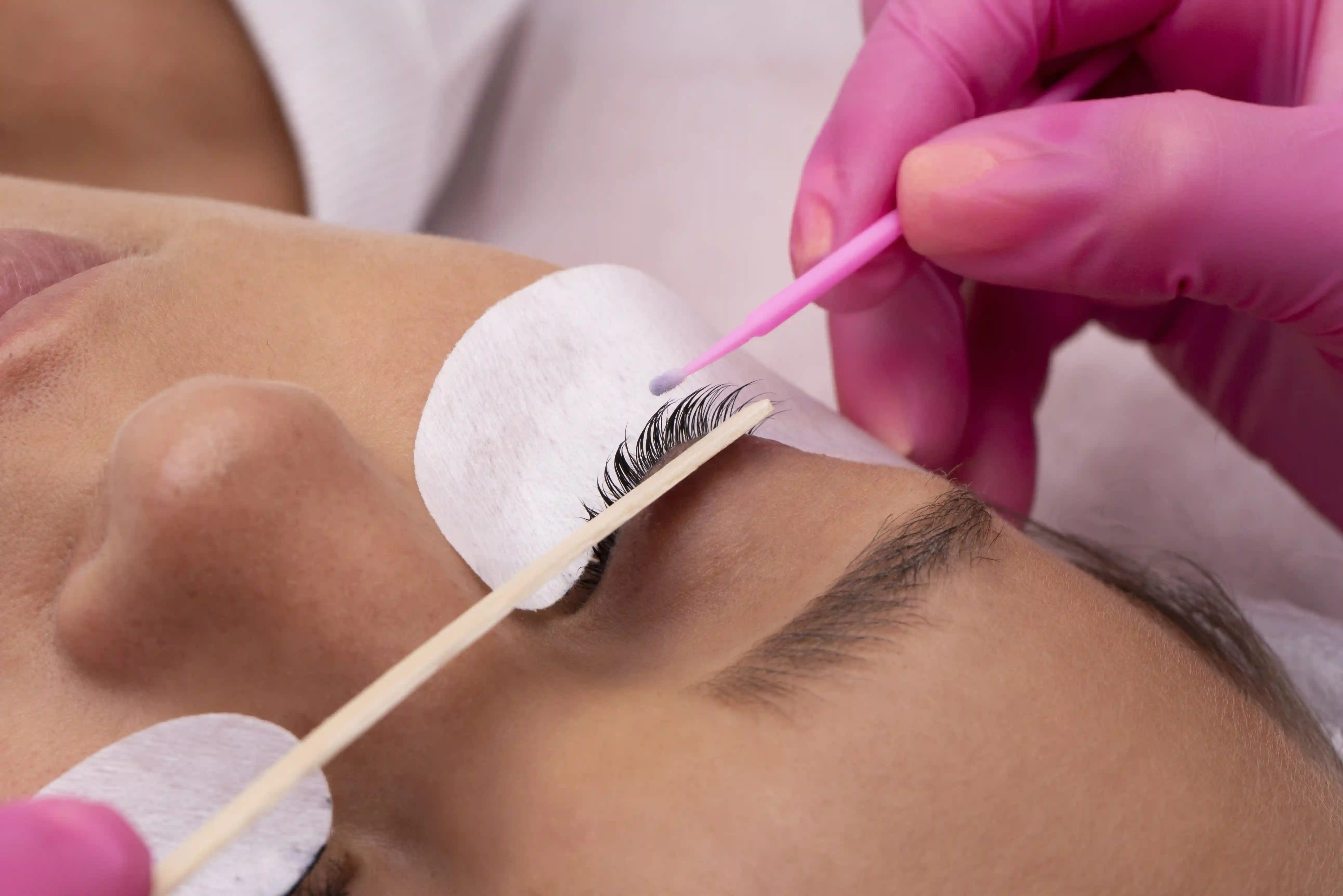 Eyelash Transplantation in Thrissur