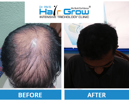 PRP before and after photo: Hair Transplant before & after results
