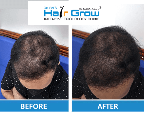 PRP before and after photo: Hair Transplant before & after results
