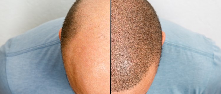 Hair Transplant In Kerala