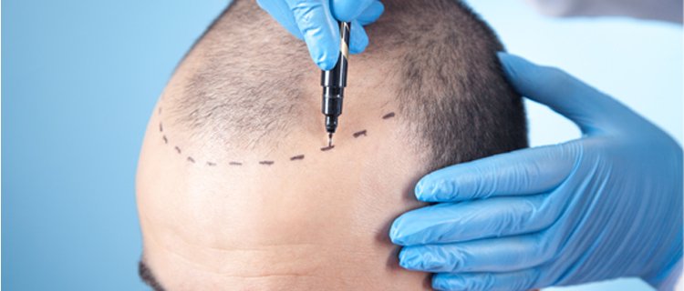 Hair Transplant In Kerala