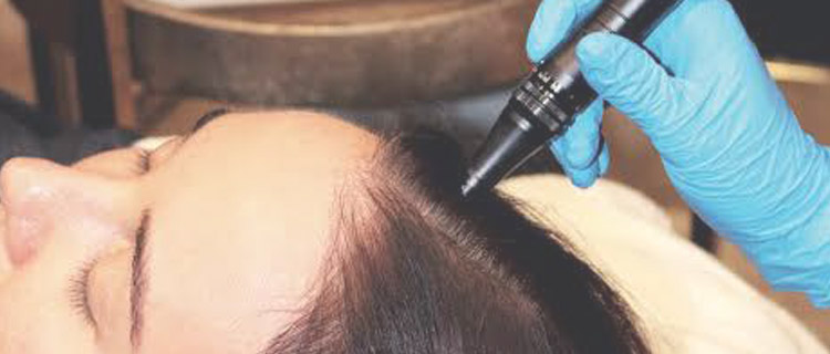 Mesotherapy for hair loss treatment in Kerala, thrissur: Mesotherapy cost