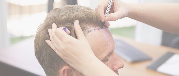 Fue Hair Transplant Cost In Kerala, Thrissur - Hair loss Treatment Fue Hair Transplant Cost In Kerala, Thrissur - Hair loss Treatment